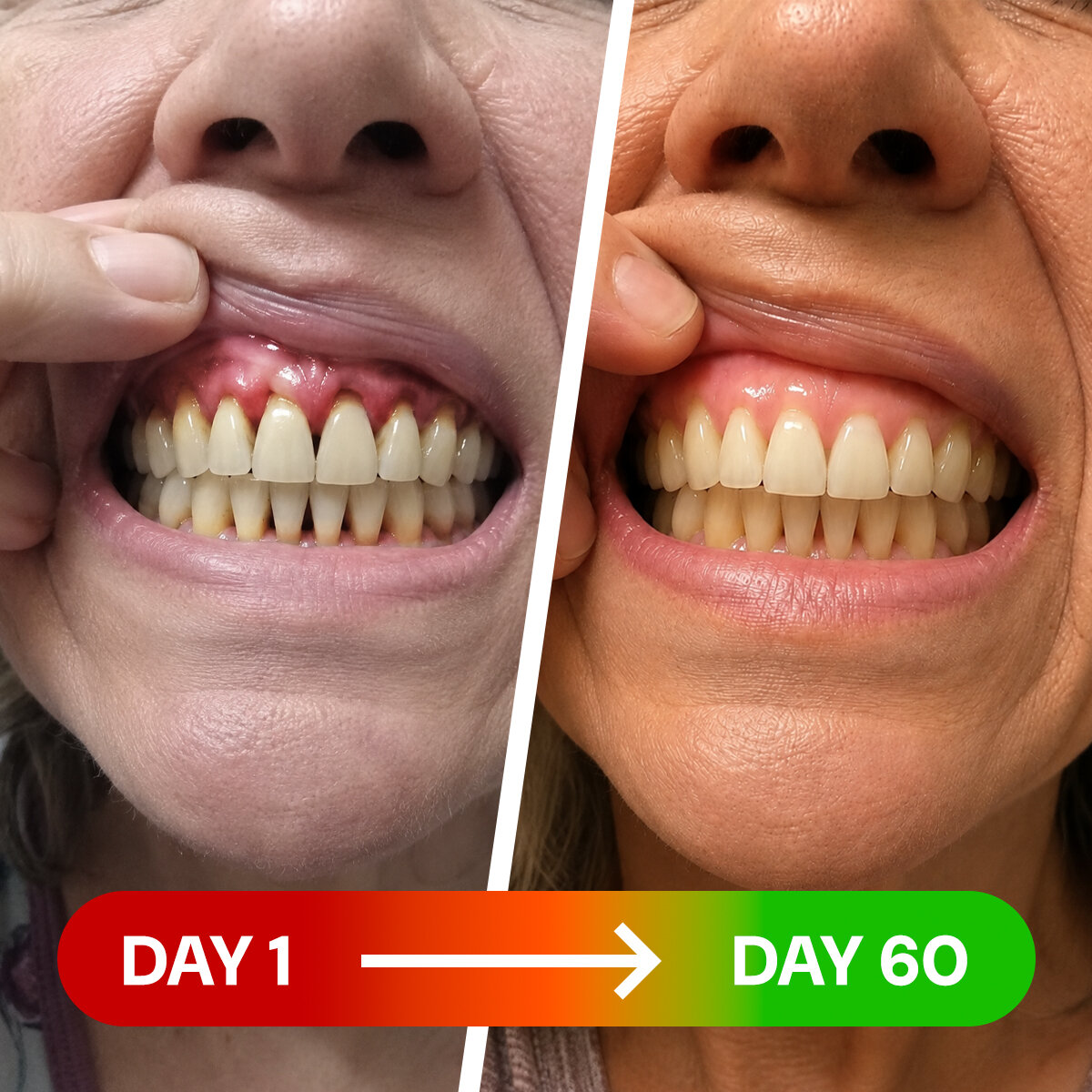 Toothcare Red Light Gum Device Benefits